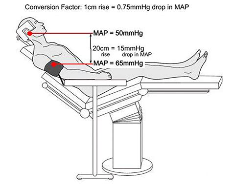 bj reflex si|Storm Anesthesia .